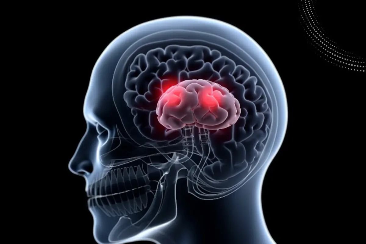 20-facts-about-brain-aneurysm-survival-rate