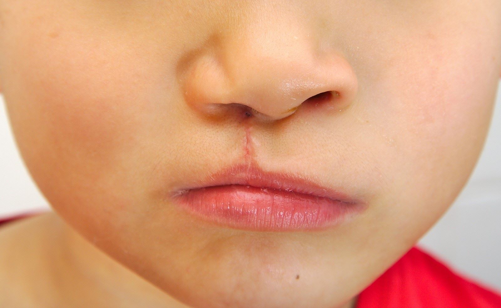 20-facts-about-cleft-lip