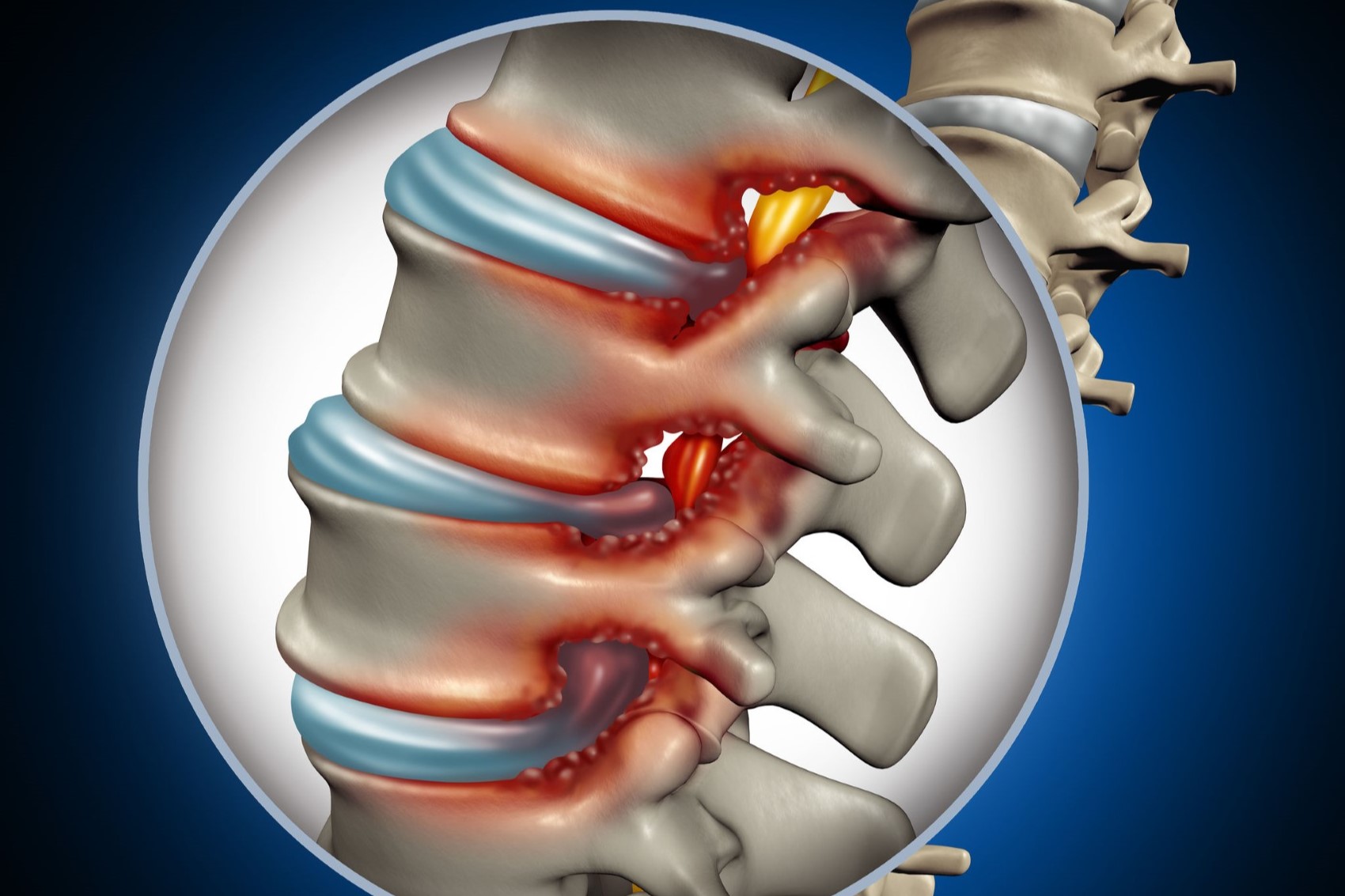 20-facts-about-spinal-stenosis