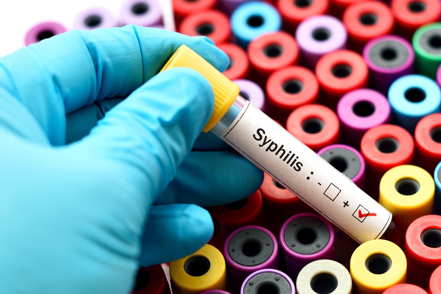 30-facts-about-syphilis-testing