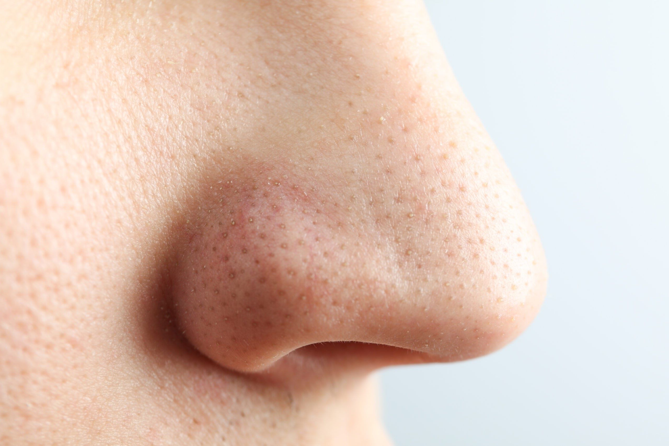 35-facts-about-blackheads