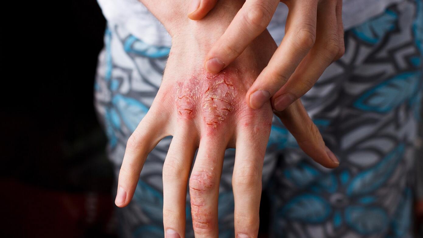 40-facts-about-atopic-dermatitis