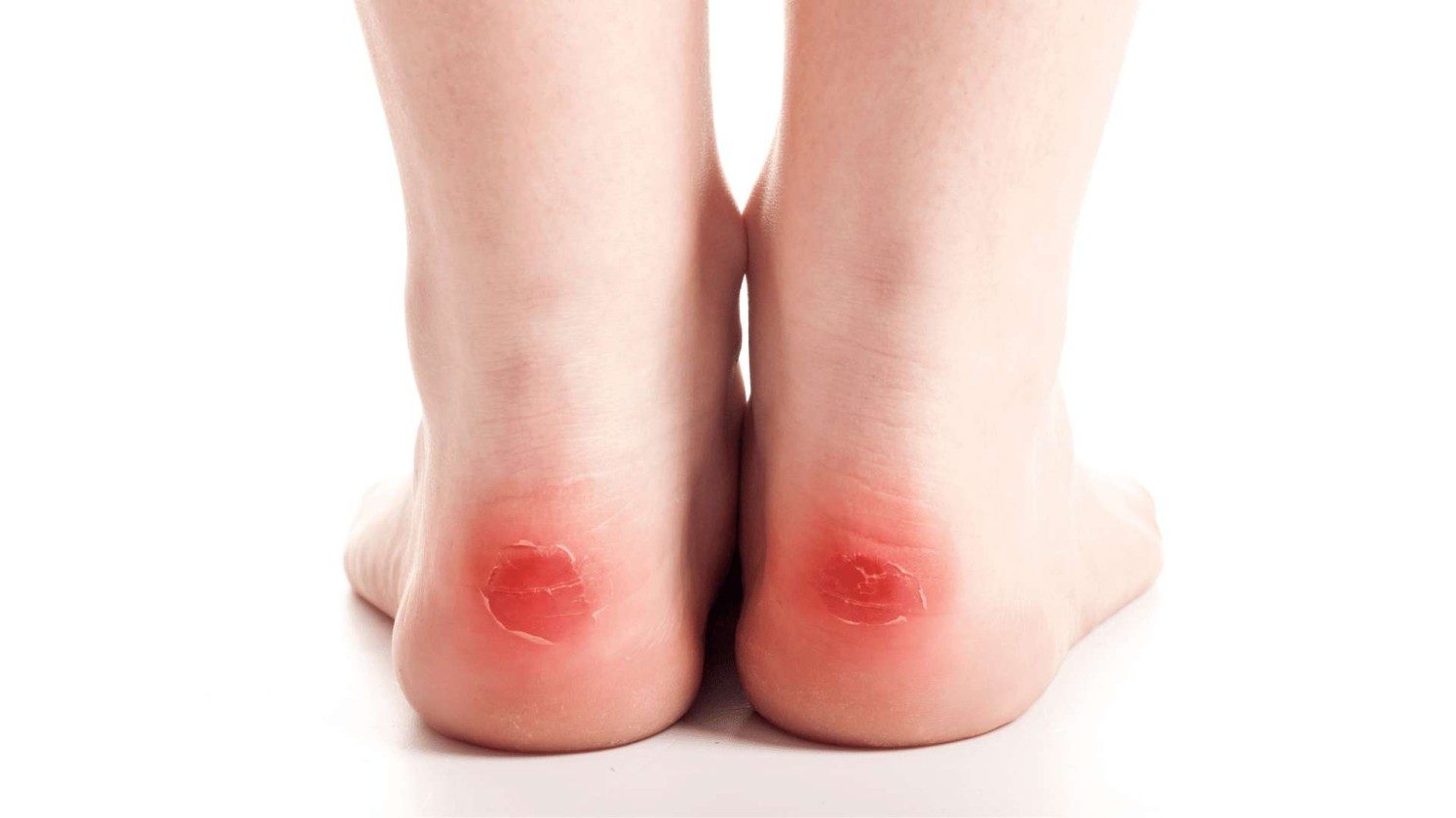 40-facts-about-blisters