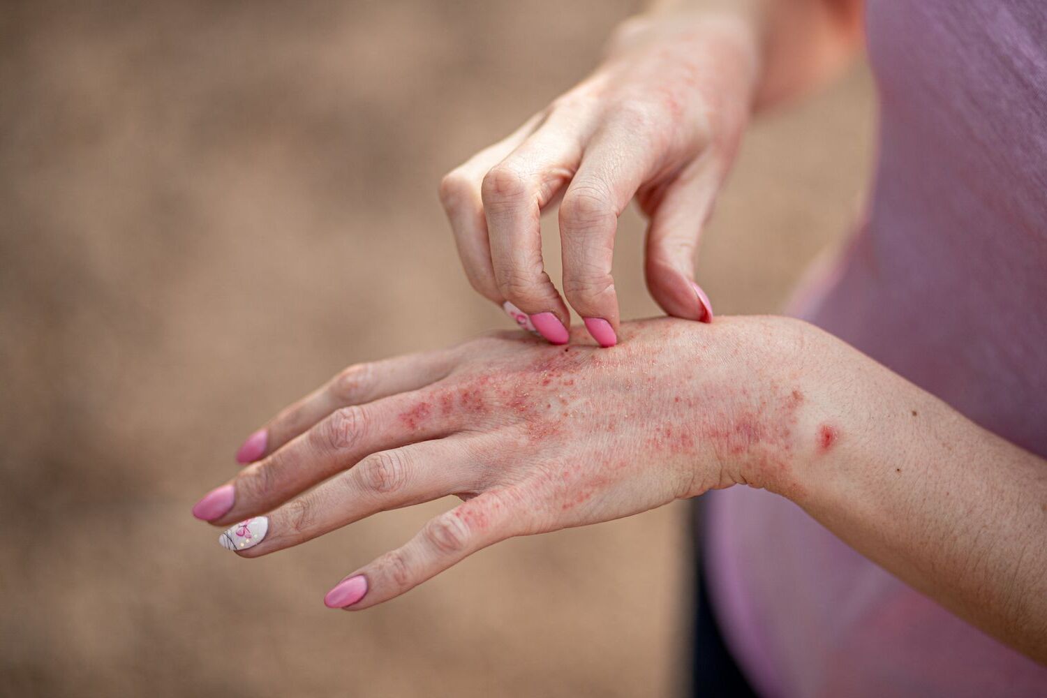 40-facts-about-contact-dermatitis