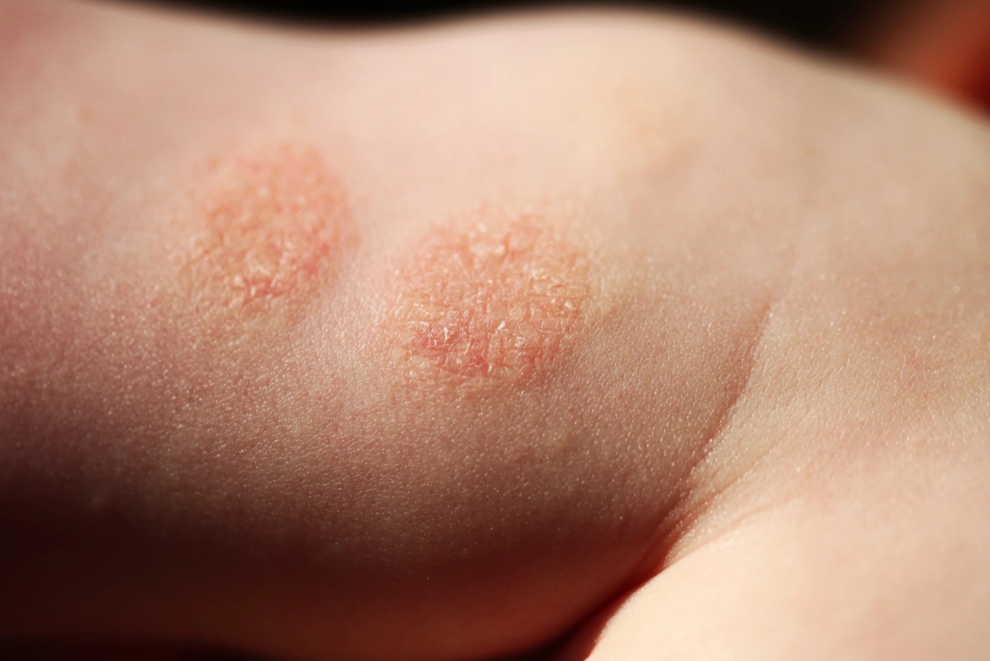 40-facts-about-discoid-eczema
