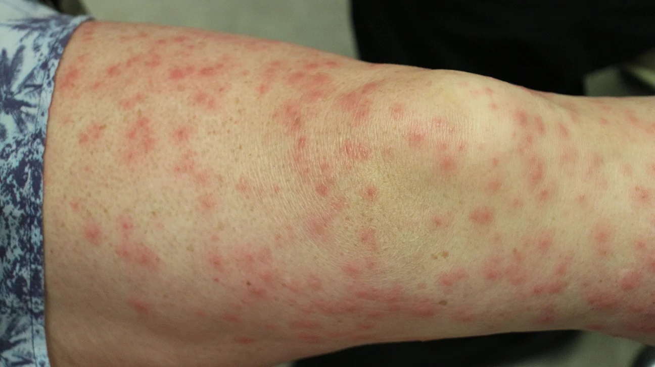 40-facts-about-scabies-rash