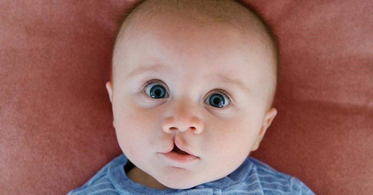 42-facts-about-cleft-lip-and-palate