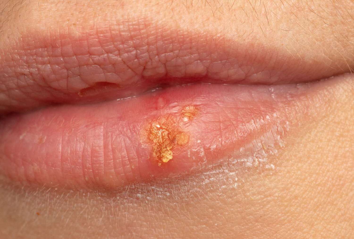 50-facts-about-cold-sores