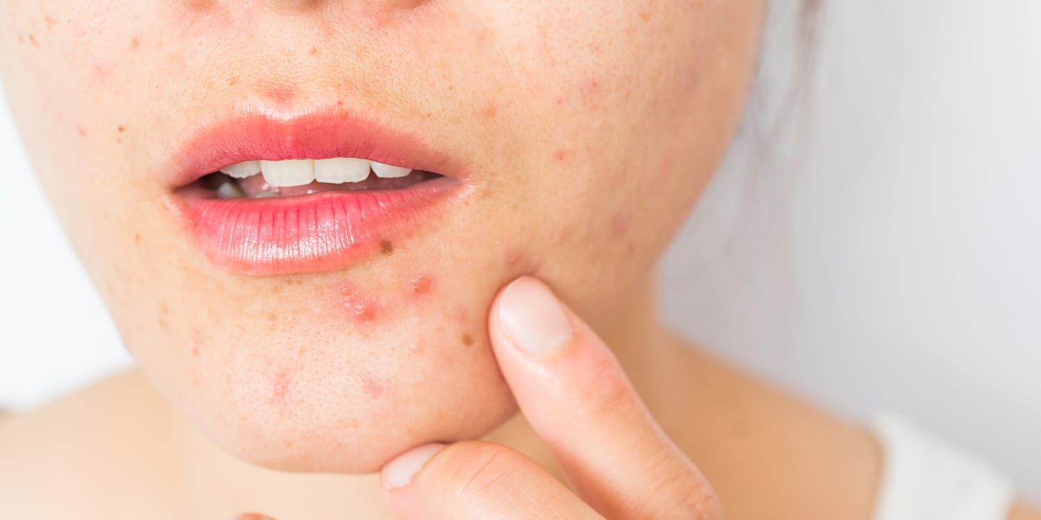 50-facts-about-cystic-acne