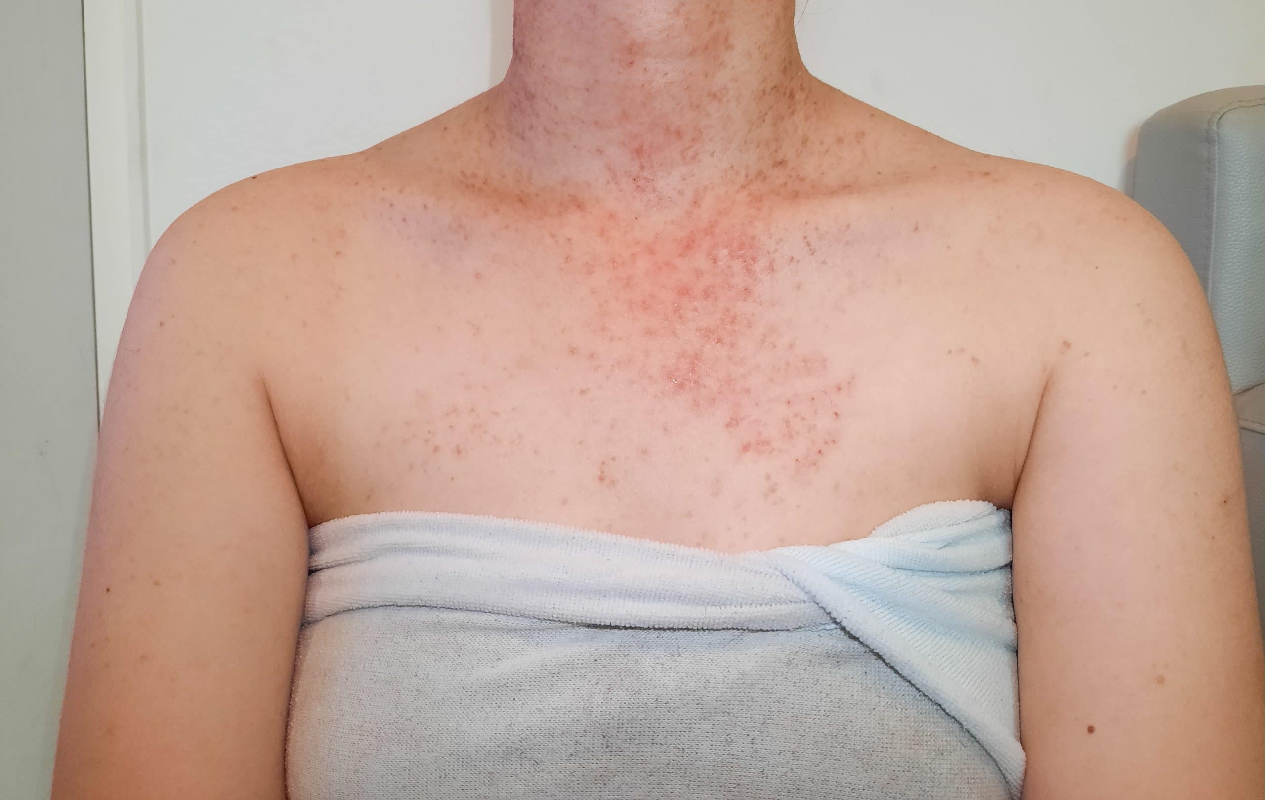 50-facts-about-folliculitis
