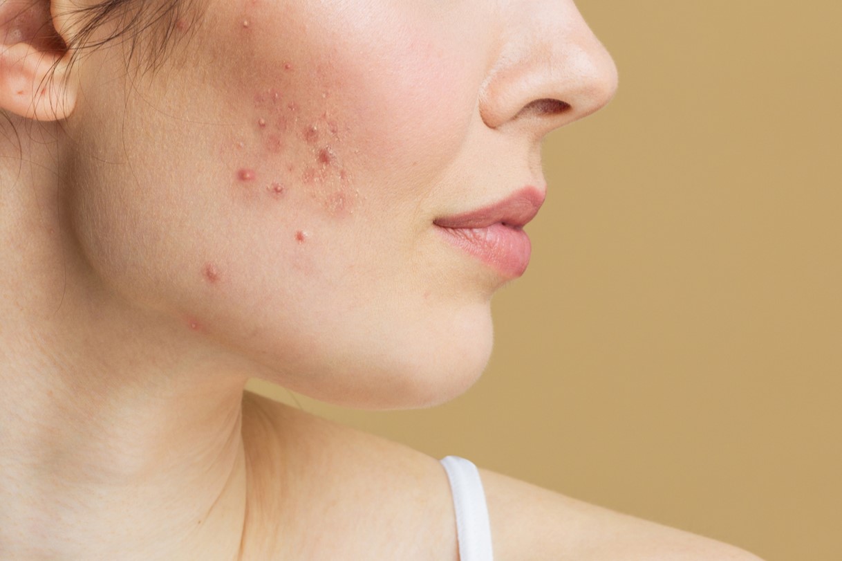 50-facts-about-hormonal-acne