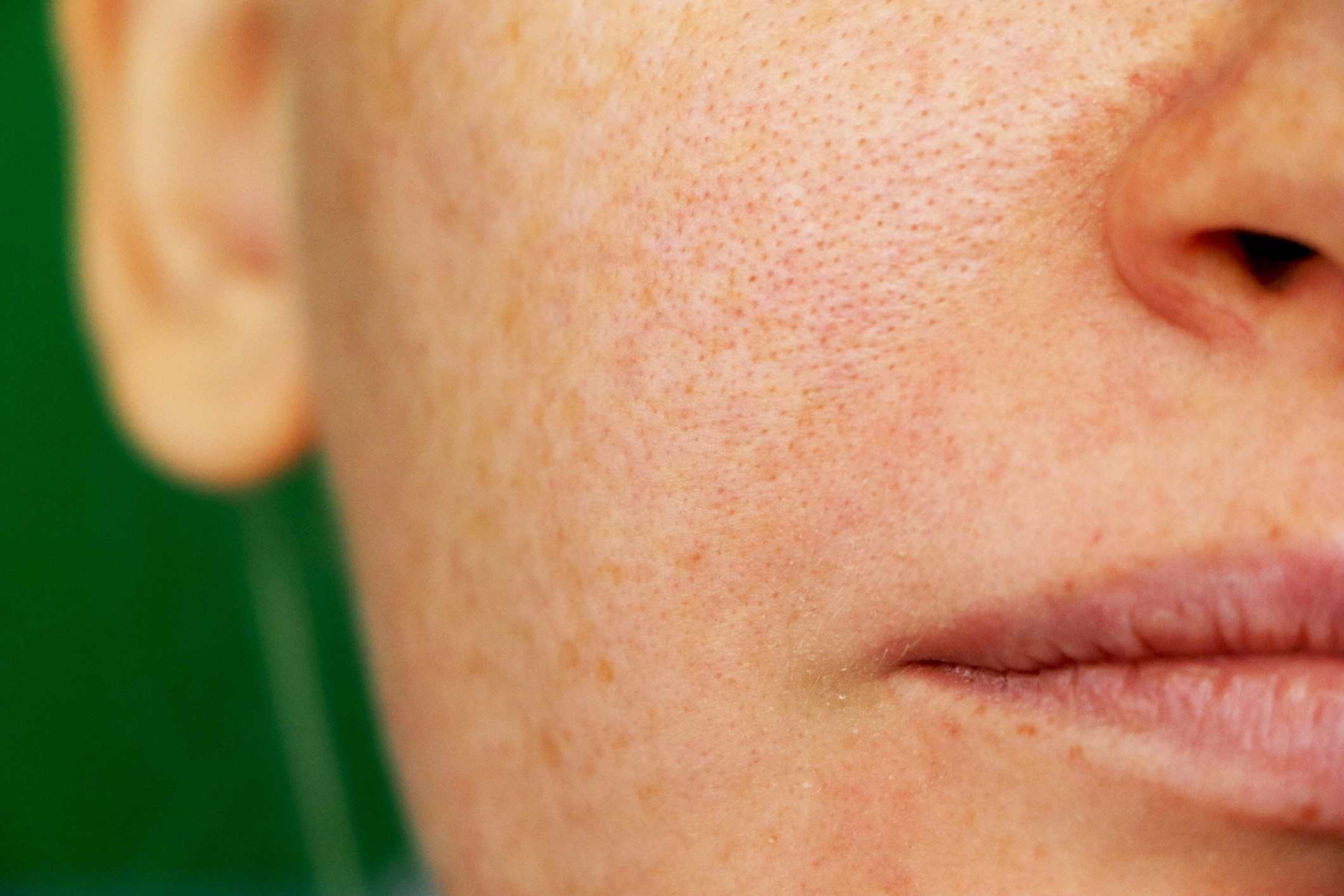 50-facts-about-melasma