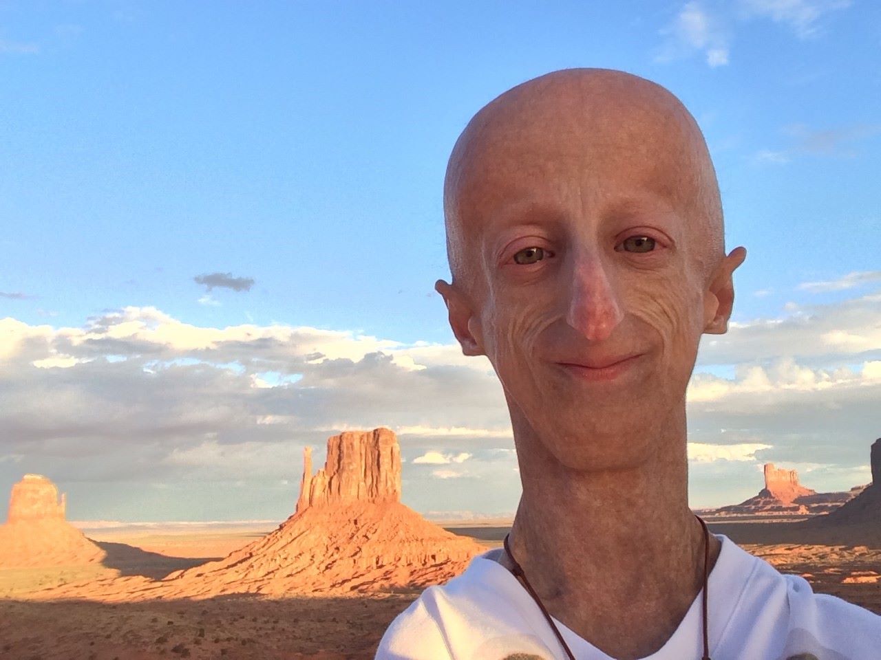 50-facts-about-progeria