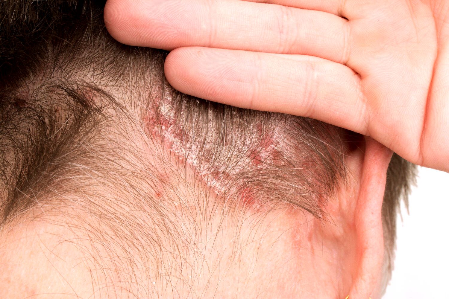 50-facts-about-seborrheic-dermatitis