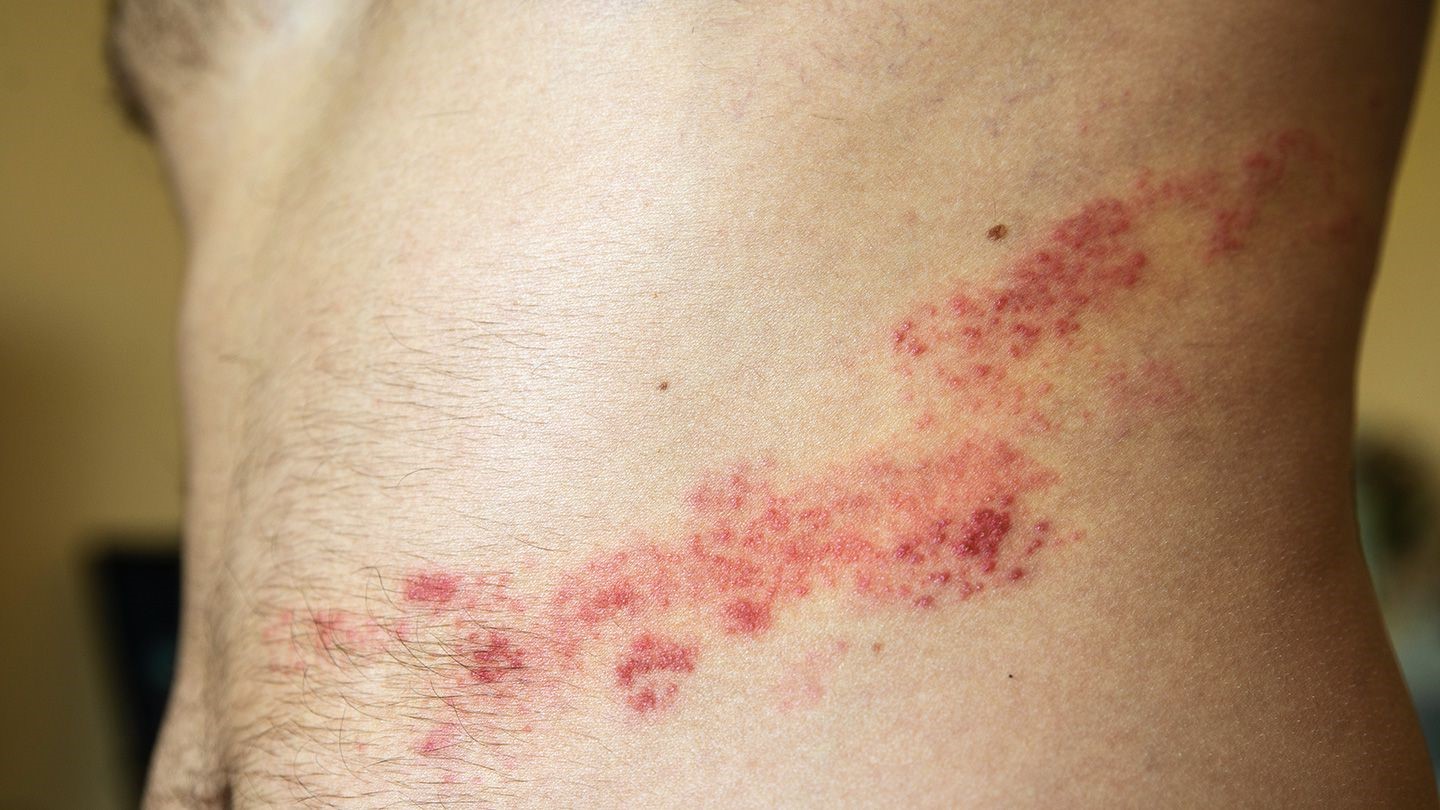 50-facts-about-shingles