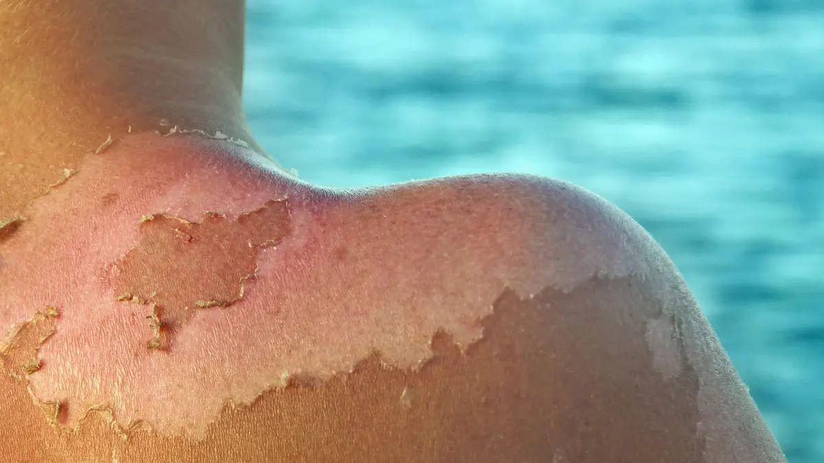 50-facts-about-sunburn