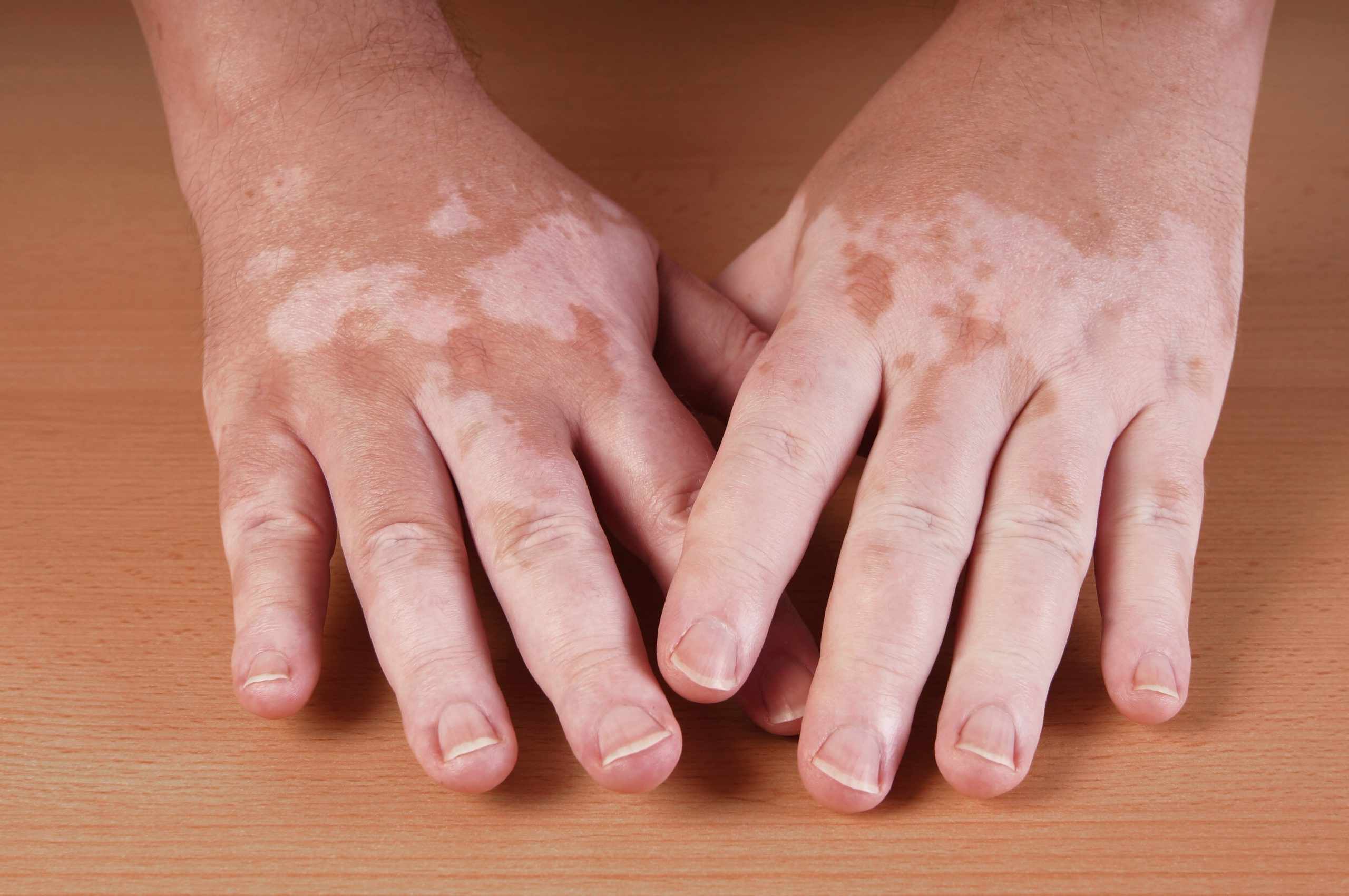 50-facts-about-vitiligo