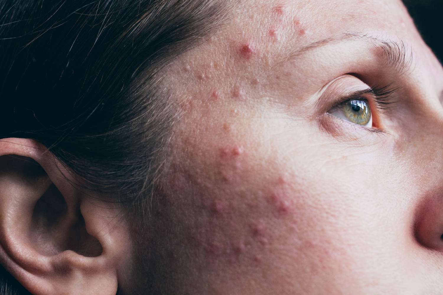 60-facts-about-acne