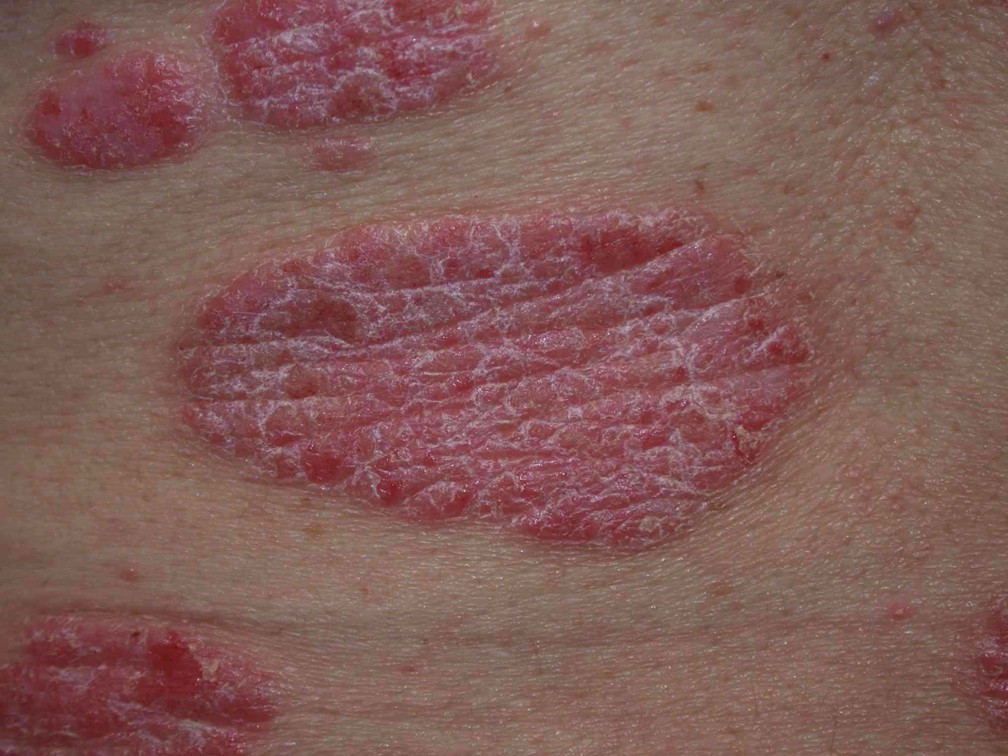 60-facts-about-psoriasis