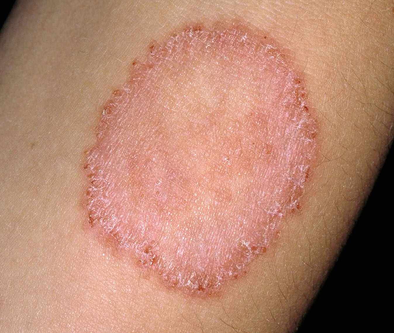 70-facts-about-ringworm