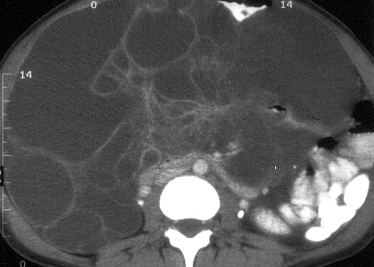 20-facts-about-abdominal-cystic-lymphangioma