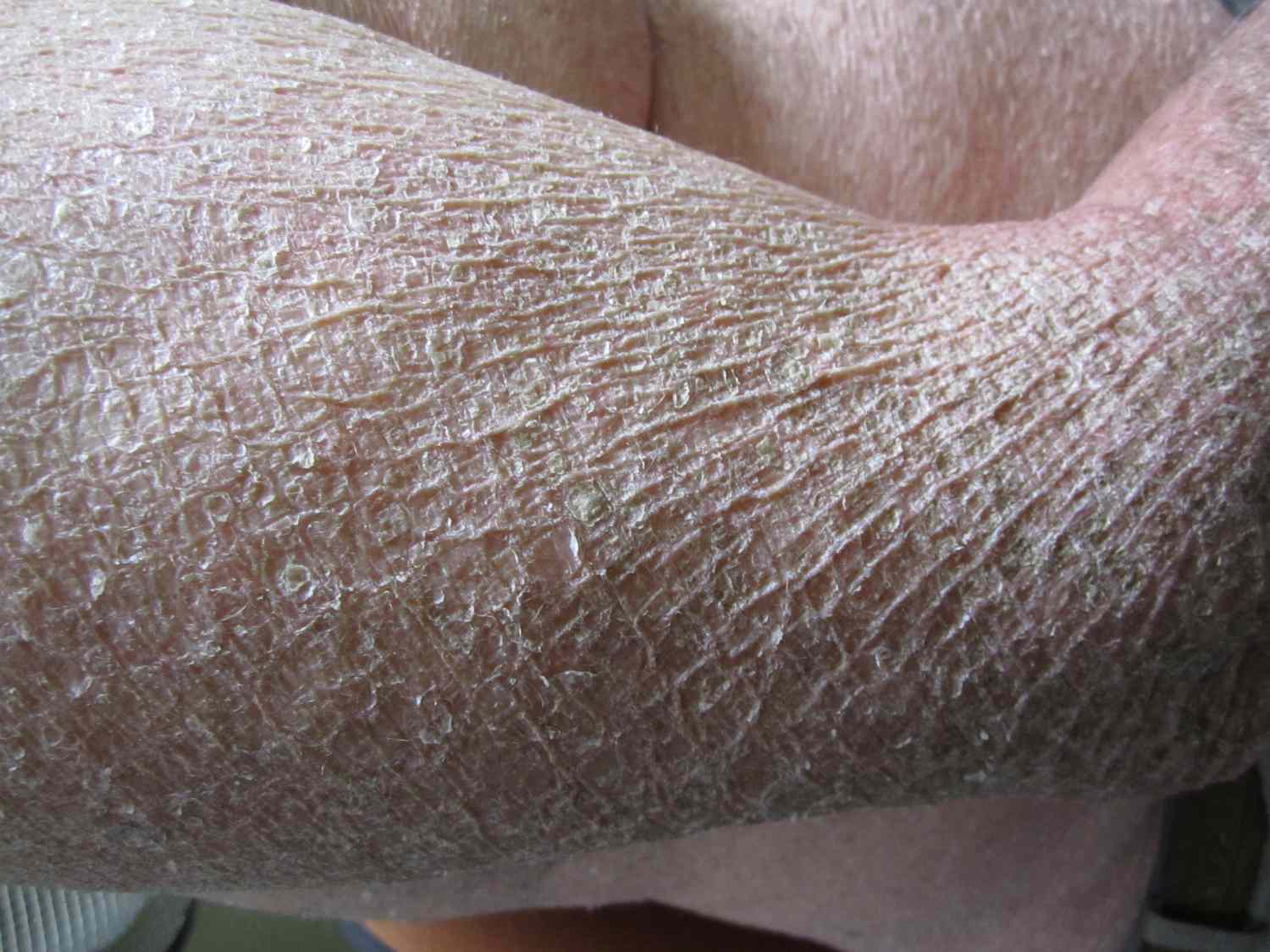 20-facts-about-acquired-ichthyosis