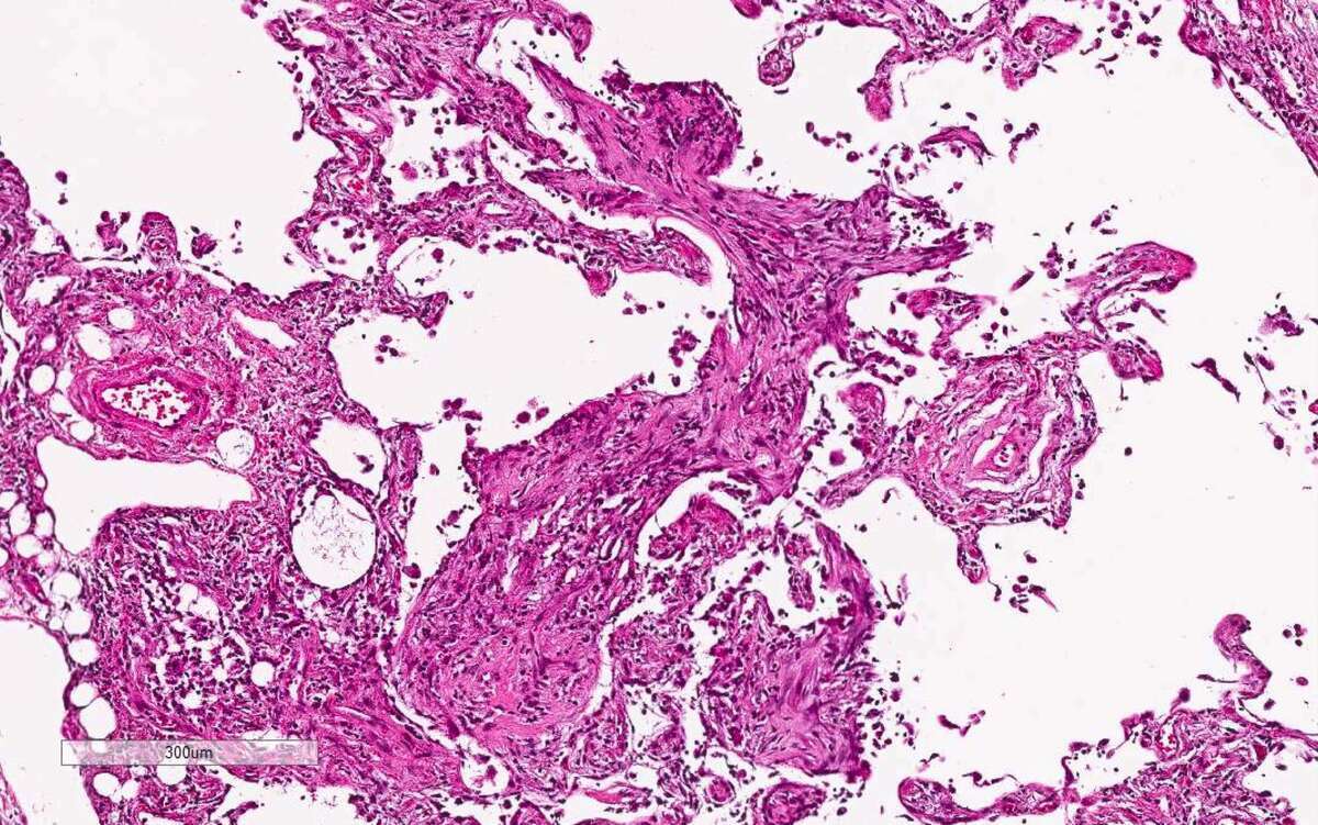 20-facts-about-acute-interstitial-pneumonitis