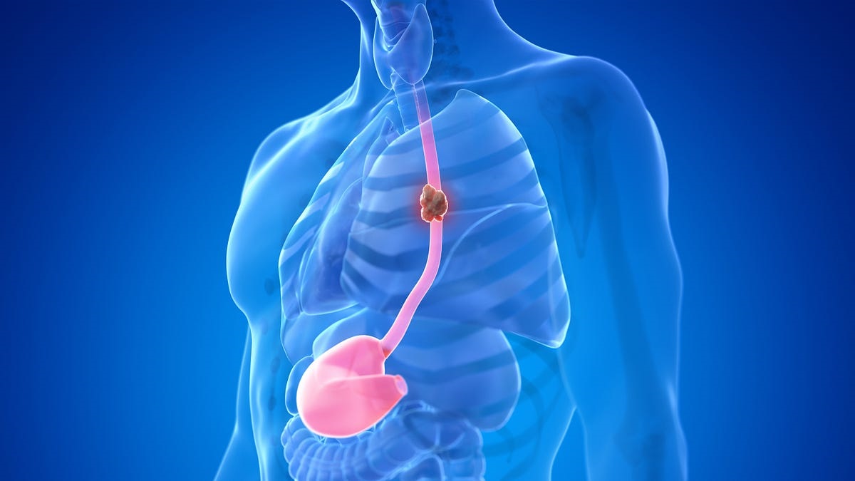 20-facts-about-adenocarcinoma-of-esophagus