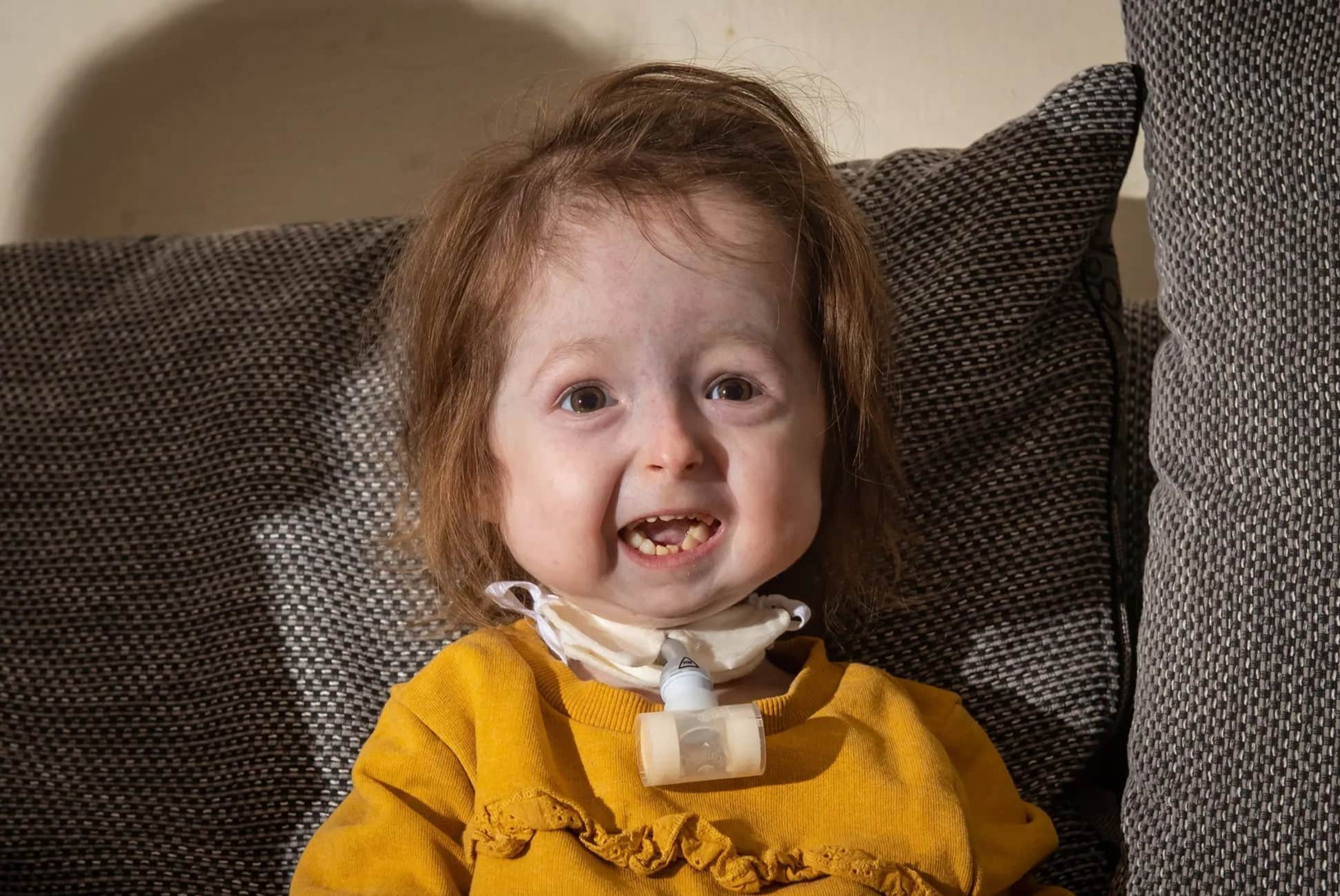 20-facts-about-benjamin-syndrome