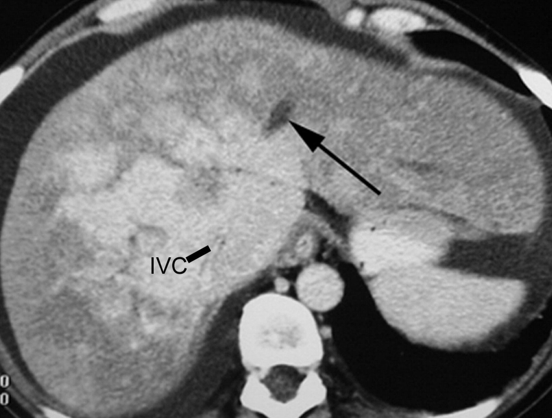 20-facts-about-budd-chiari-syndrome