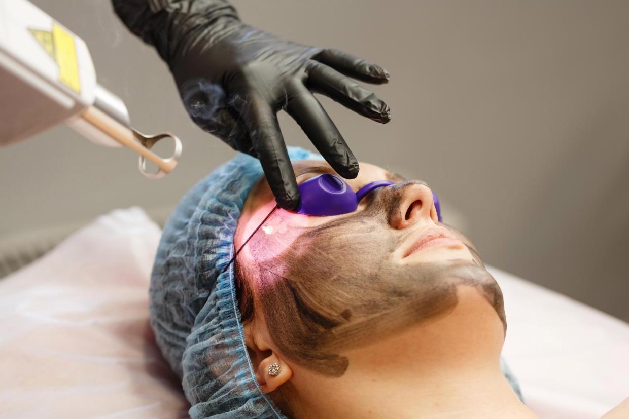 20-facts-about-carbon-laser-peel