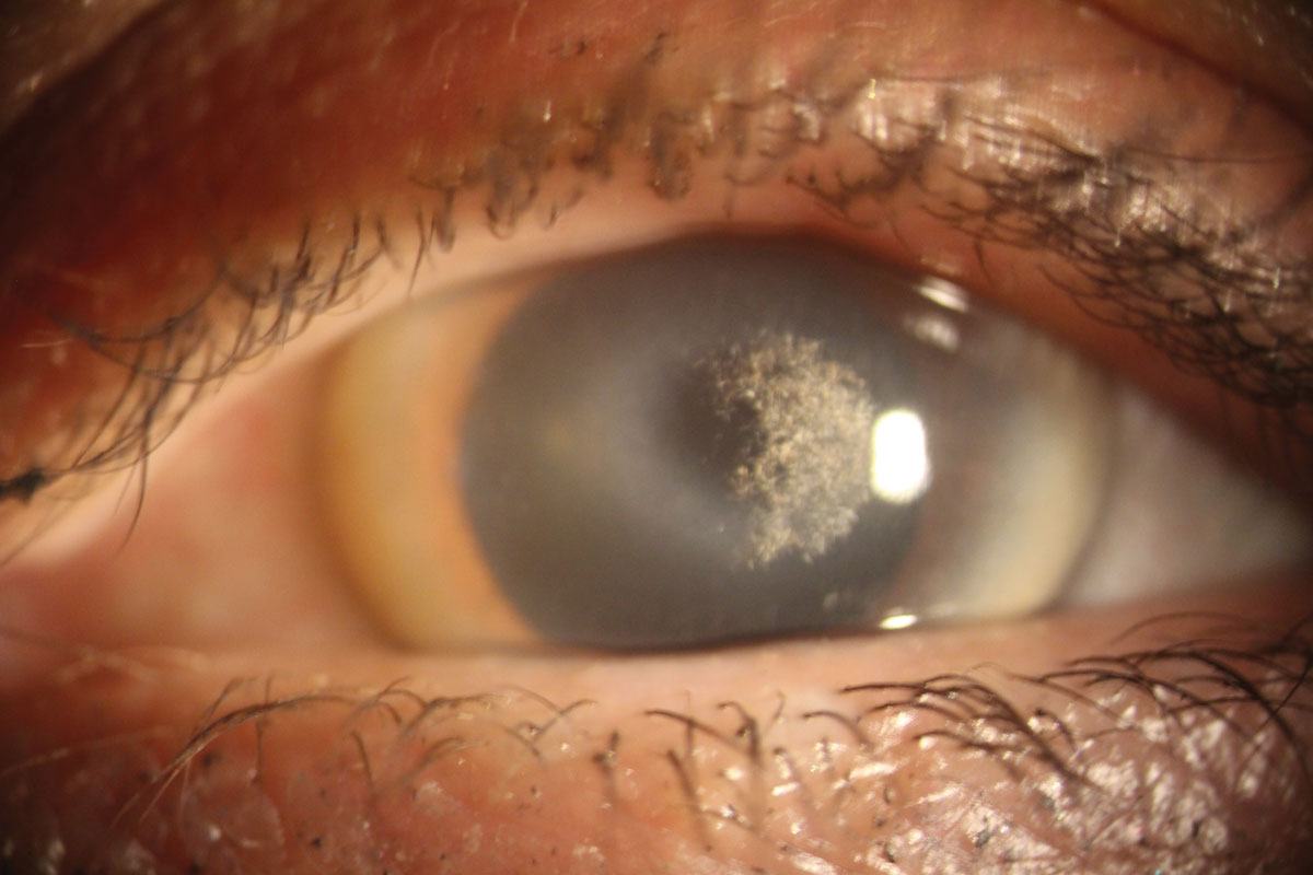 20-facts-about-corneal-dystrophy-perceptive-deafness-syndrome