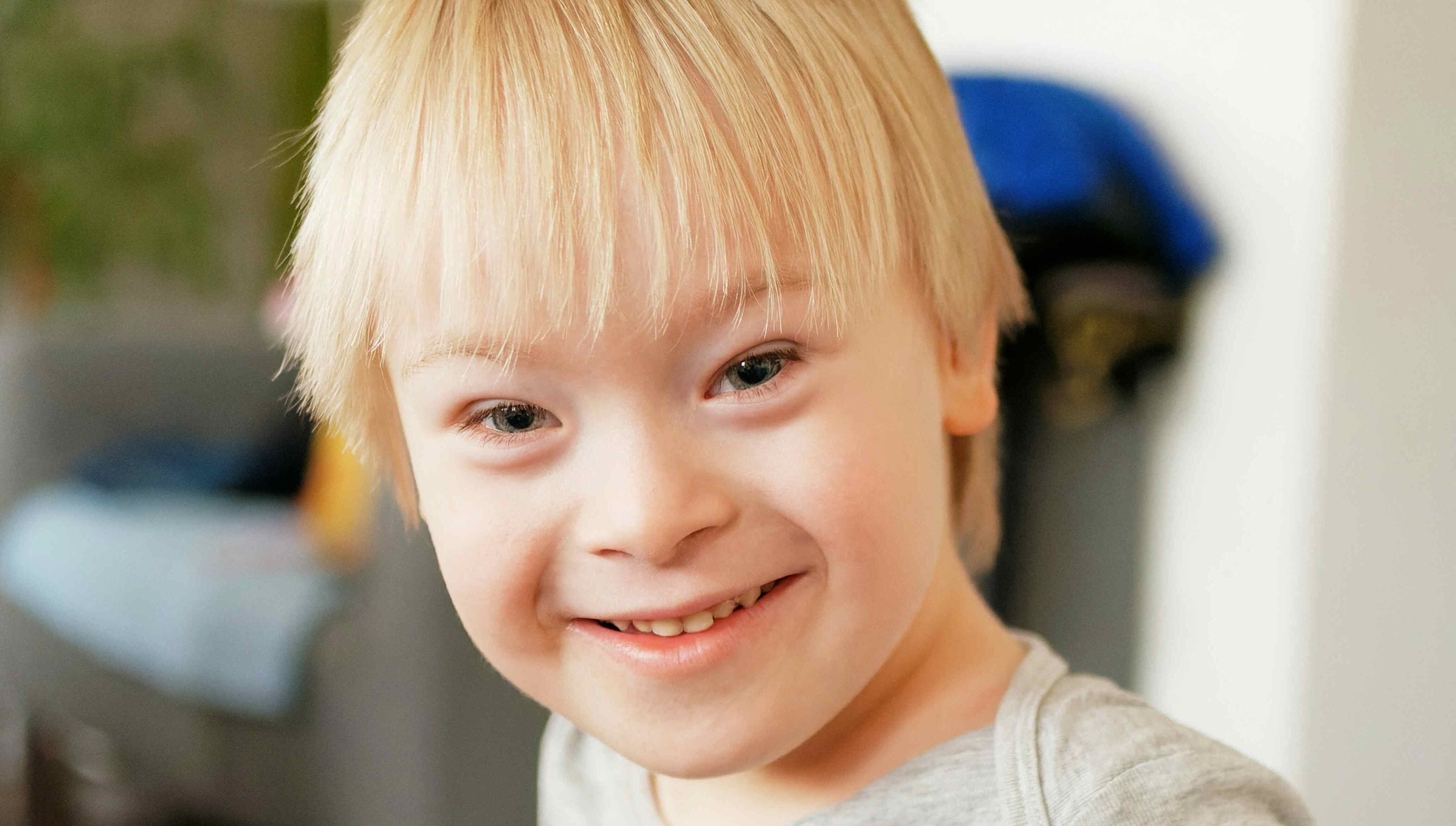 20-facts-about-young-simpson-syndrome