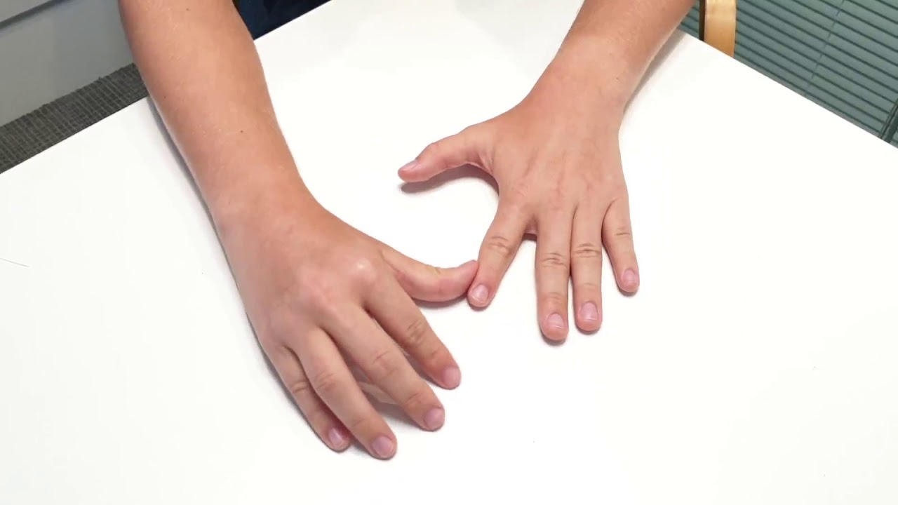 22-facts-about-adducted-thumb-syndrome