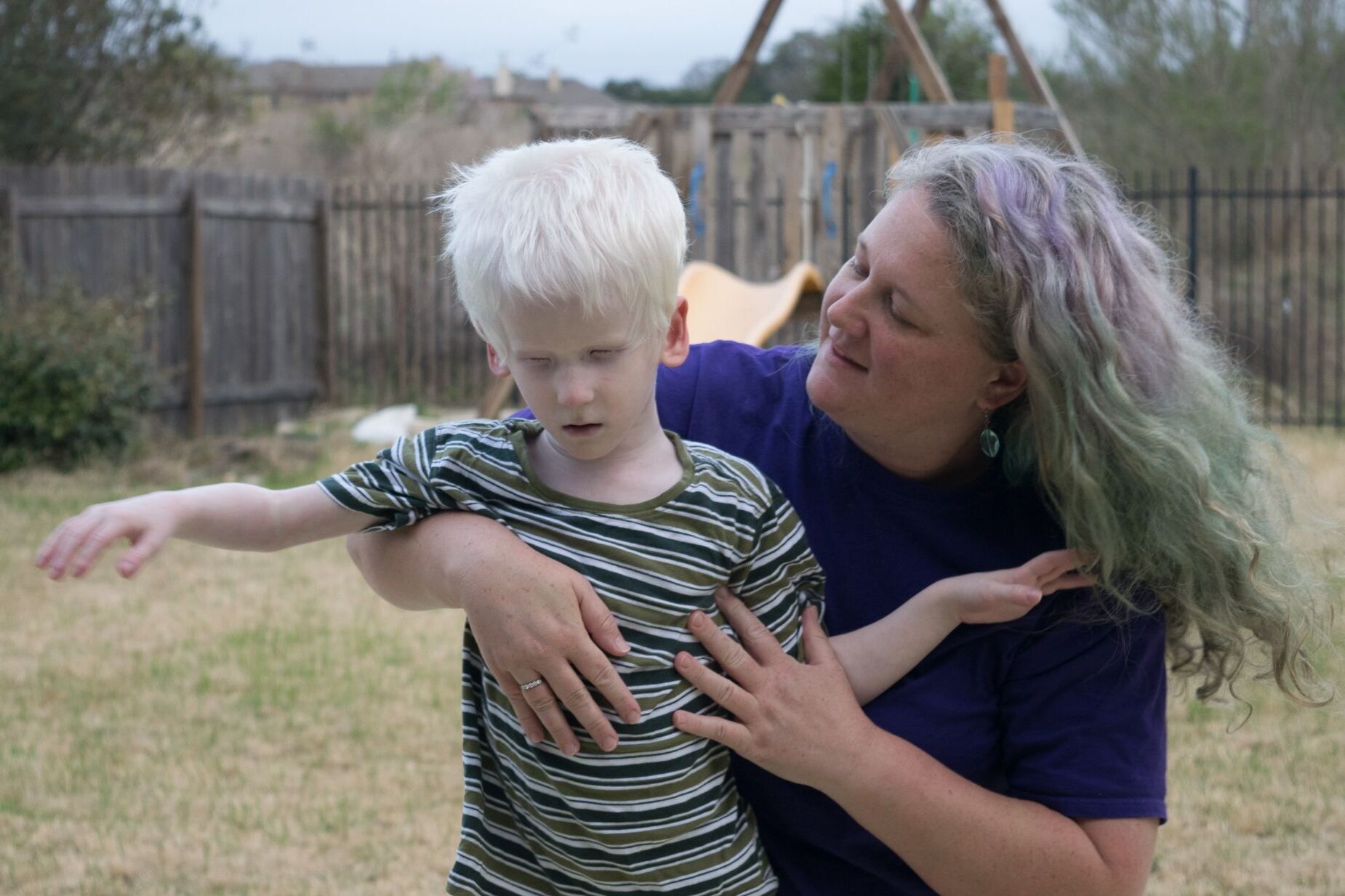 22-facts-about-albinism-deafness-syndrome