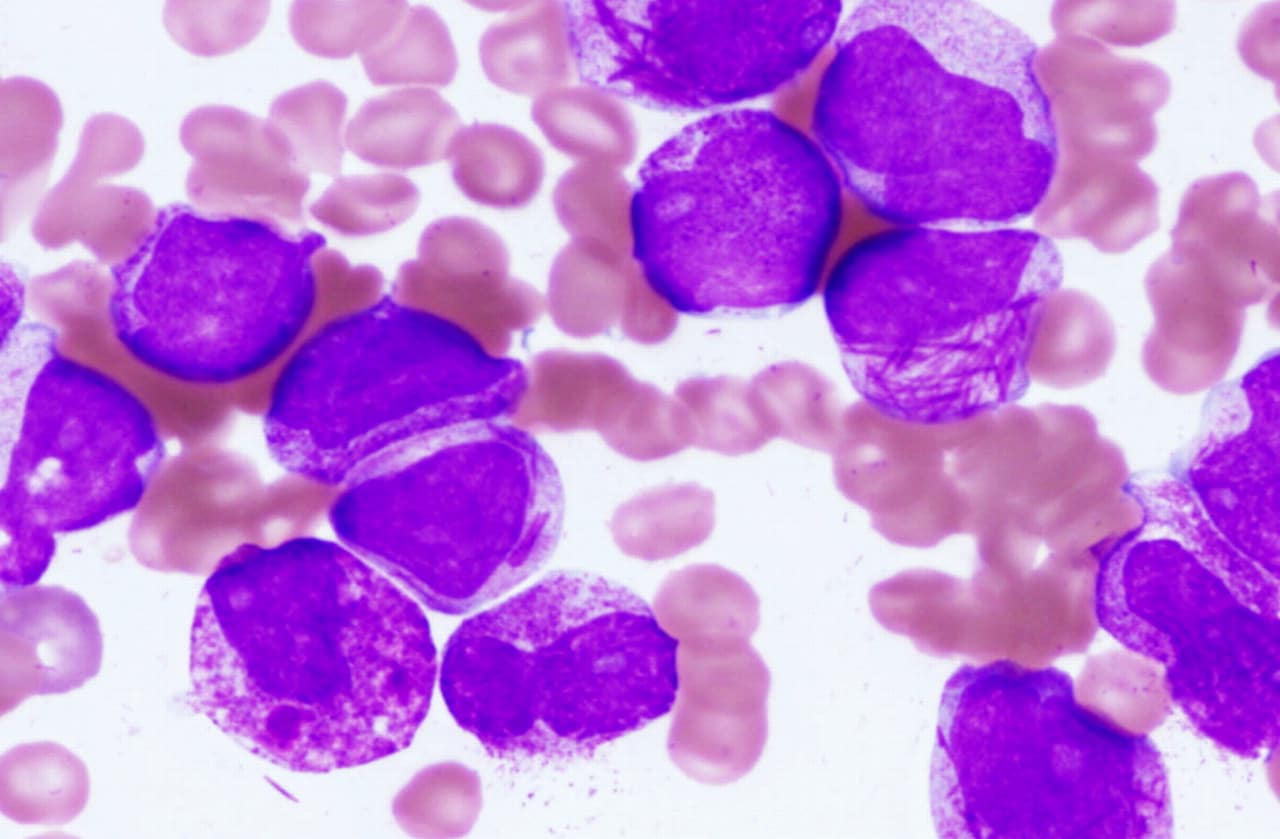 25-facts-about-acute-promyelocytic-leukemia