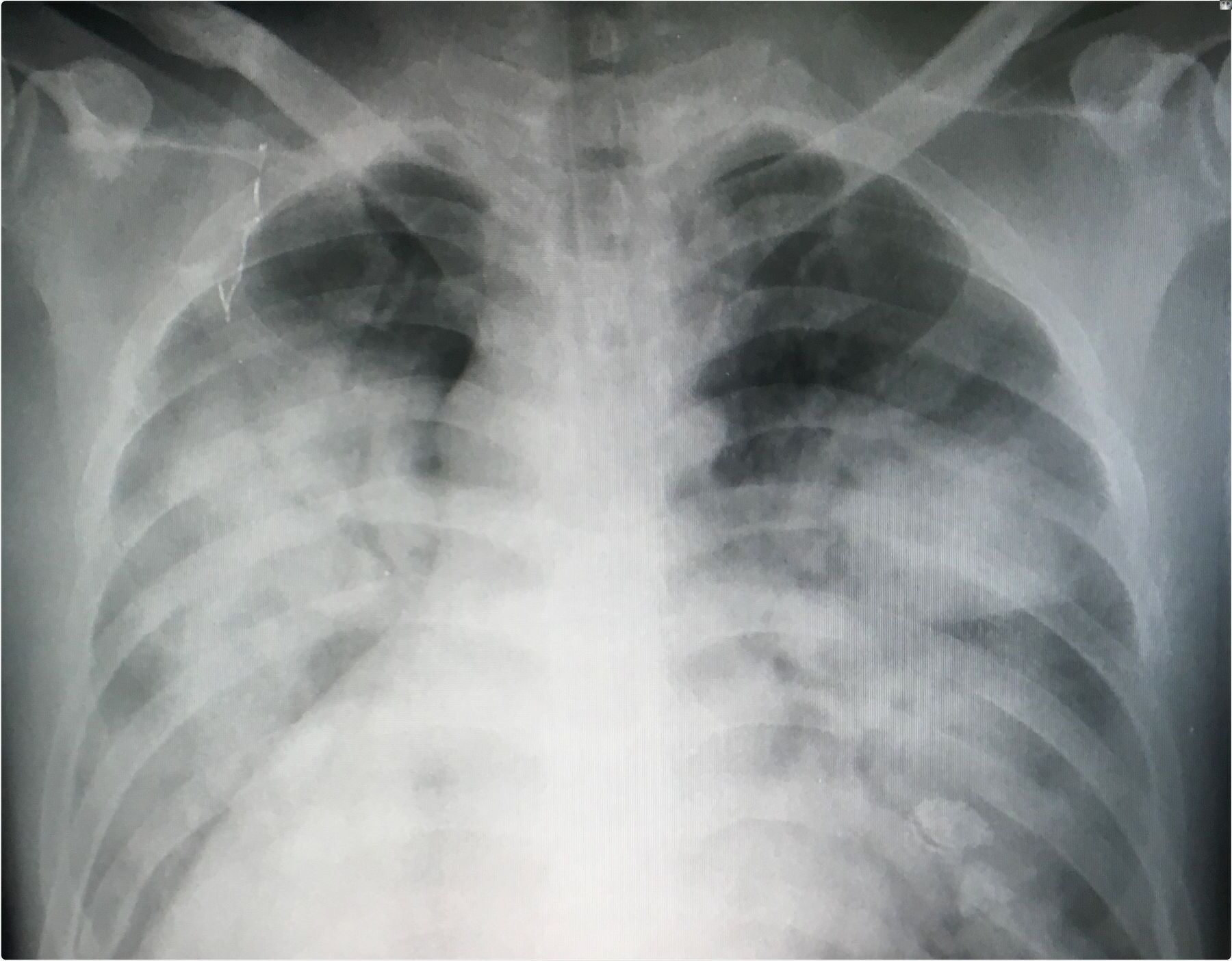 25-facts-about-acute-respiratory-distress-syndrome