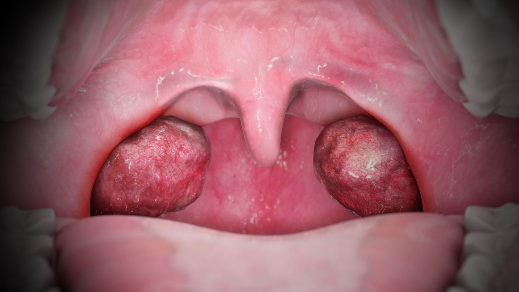 25-facts-about-tonsillitis