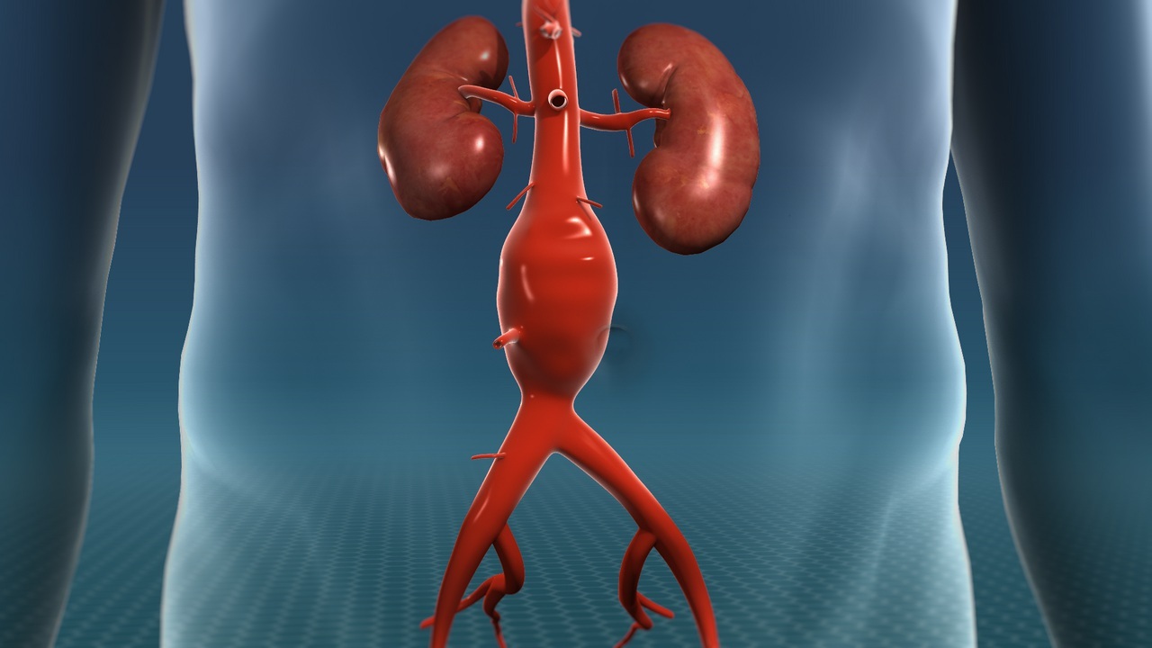 29-facts-about-abdominal-aortic-aneurysm