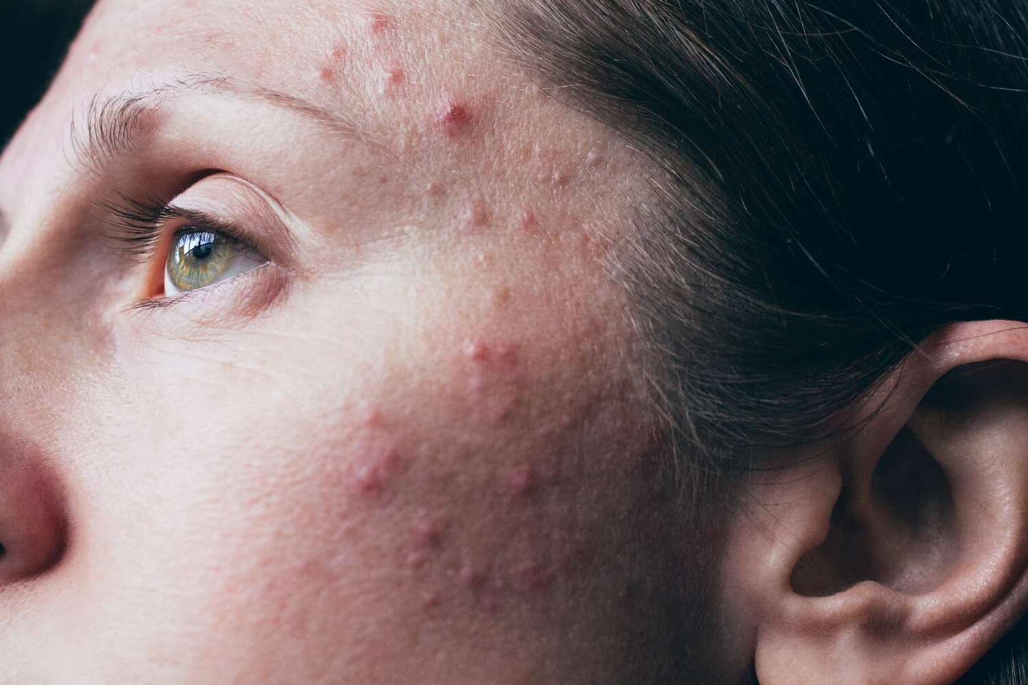 29-facts-about-acne-vulgaris