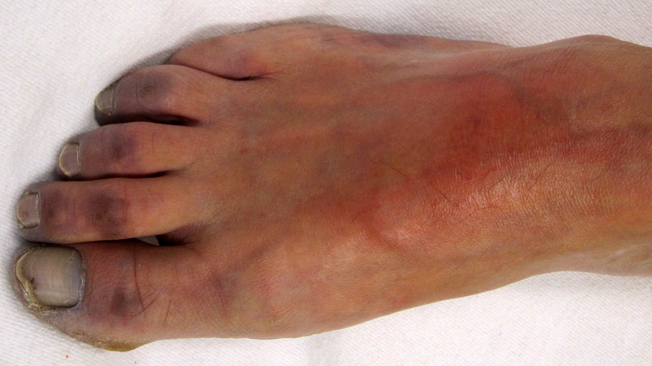 30-facts-about-blue-toe-syndrome