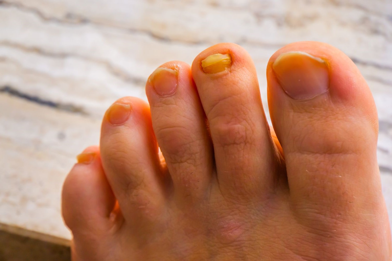 30-facts-about-yellow-nail-syndrome
