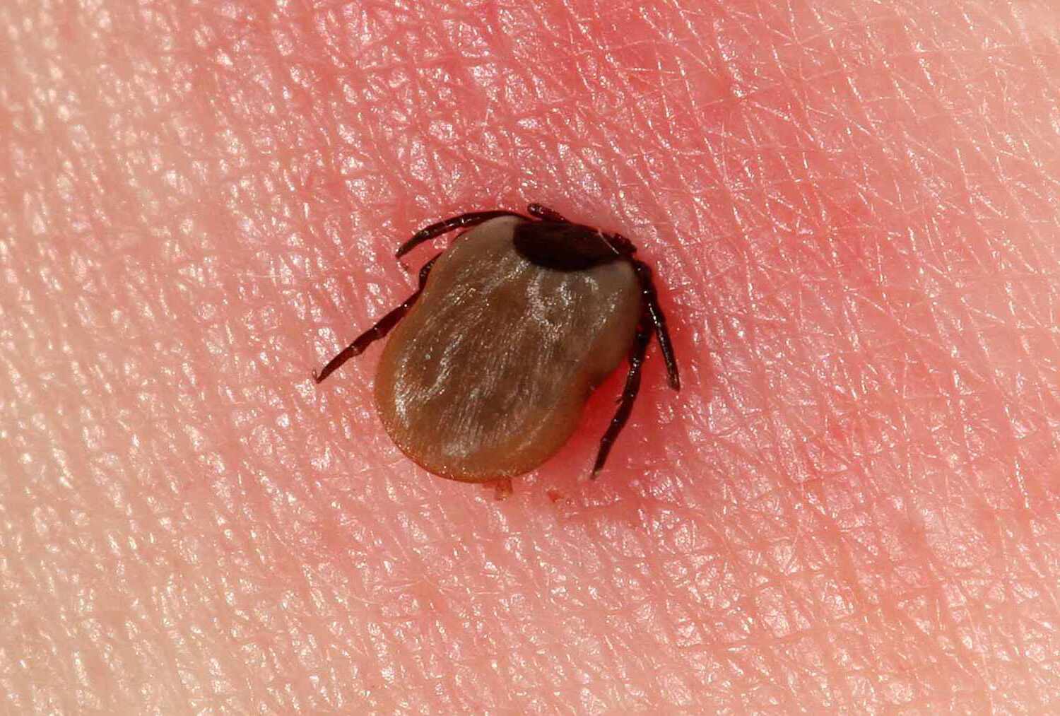 35-facts-about-lyme-disease