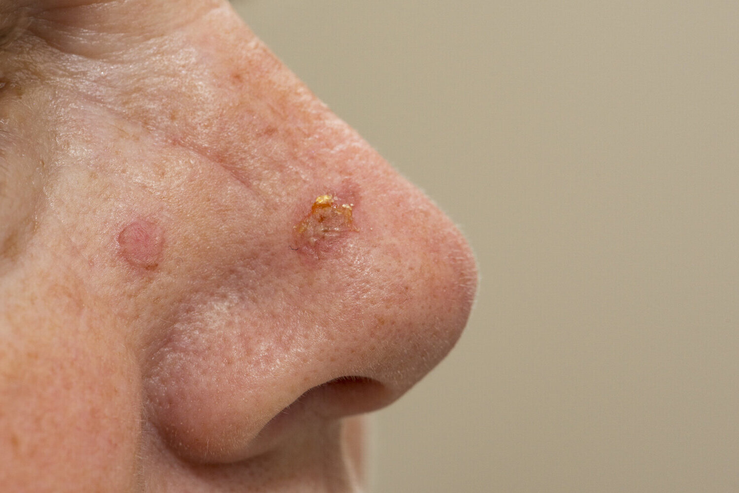 40-facts-about-actinic-keratosis