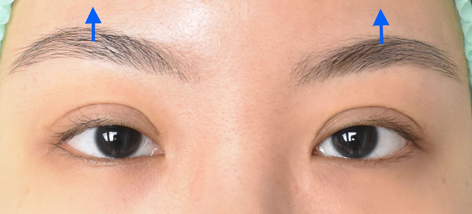 40-facts-about-ptosis