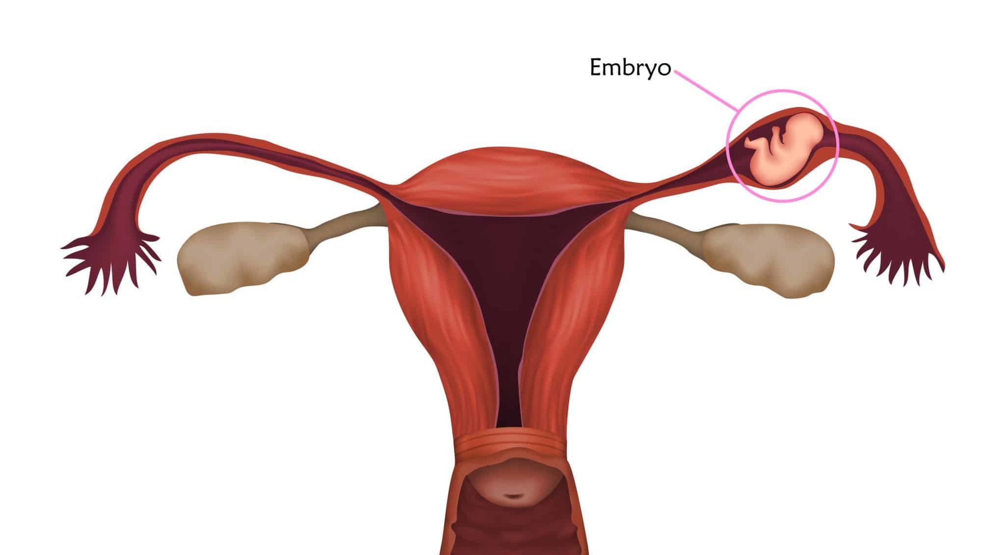 50-facts-about-ectopic-pregnancy