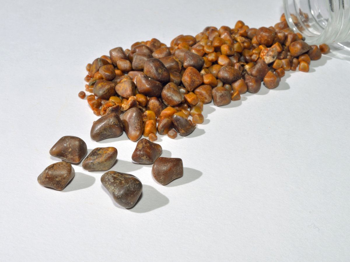 50-facts-about-gallstones