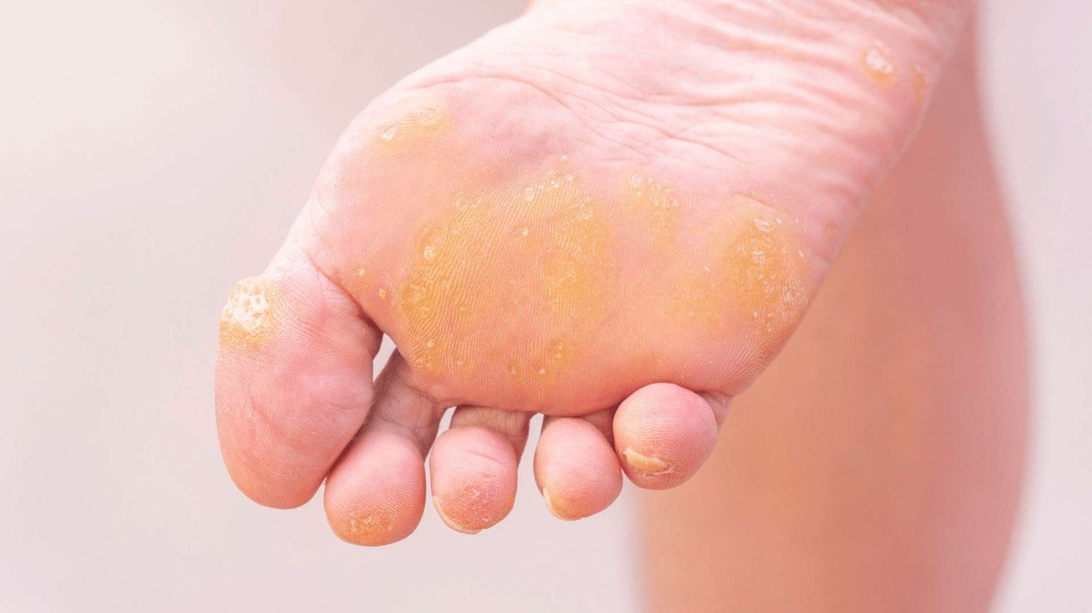 25-facts-about-callus-disease