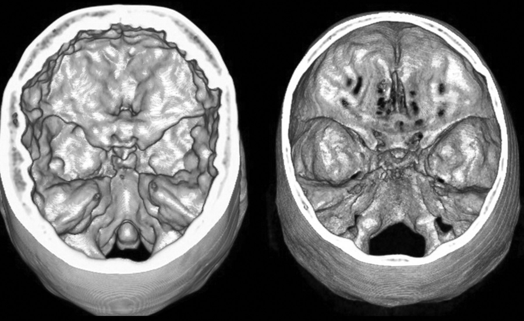 25-facts-about-calvarial-hyperostosis