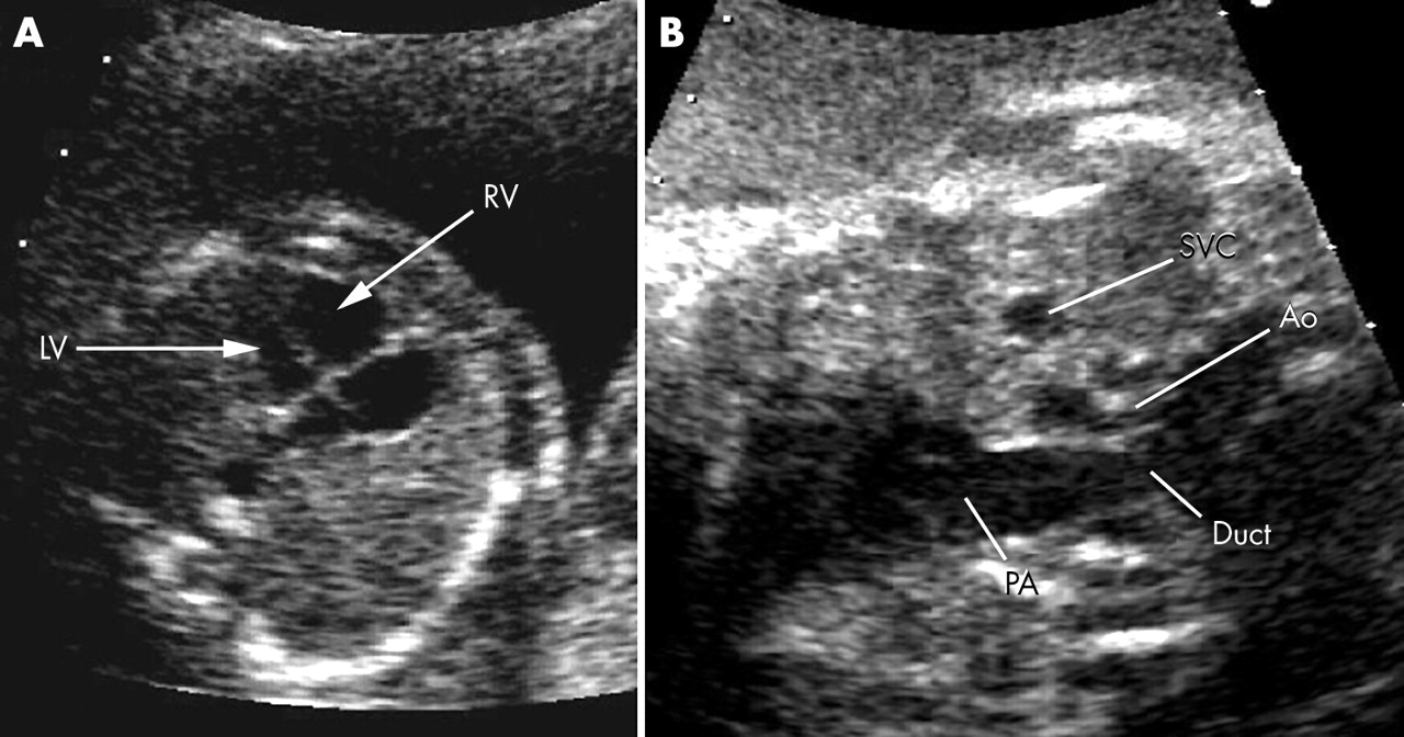 25-facts-about-coarctation-of-aorta-dominant